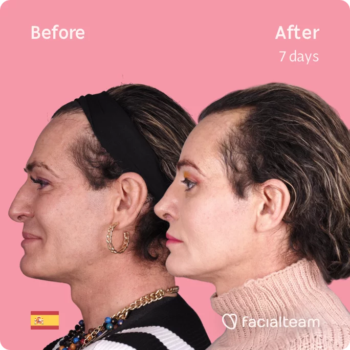 Square left side image of FFS patient Paris showing the results before and after facial feminization surgery with Facialteam consisting of forehead, rhinoplasty feminization surgery.