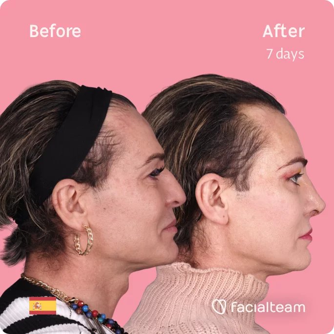 Square right side image of FFS patient Paris looking up showing the results before and after facial feminization surgery with Facialteam consisting of forehead, rhinoplasty feminization surgery.