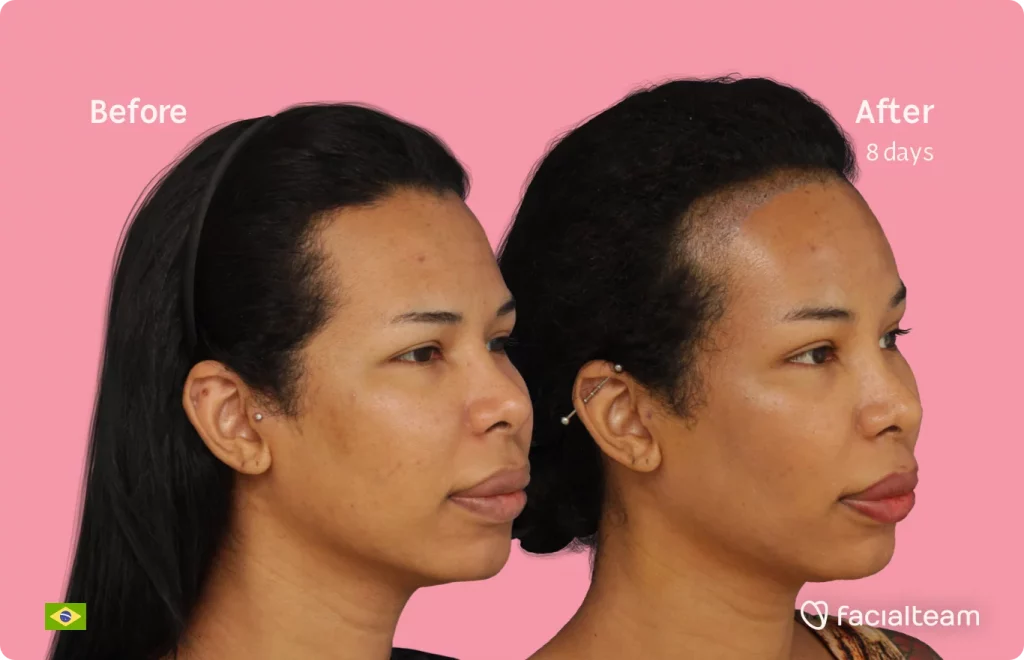 Right 45 degree image of FFS patient Daniella showing the results before and after facial feminization surgery consisting of forehead with SHT feminization surgery.