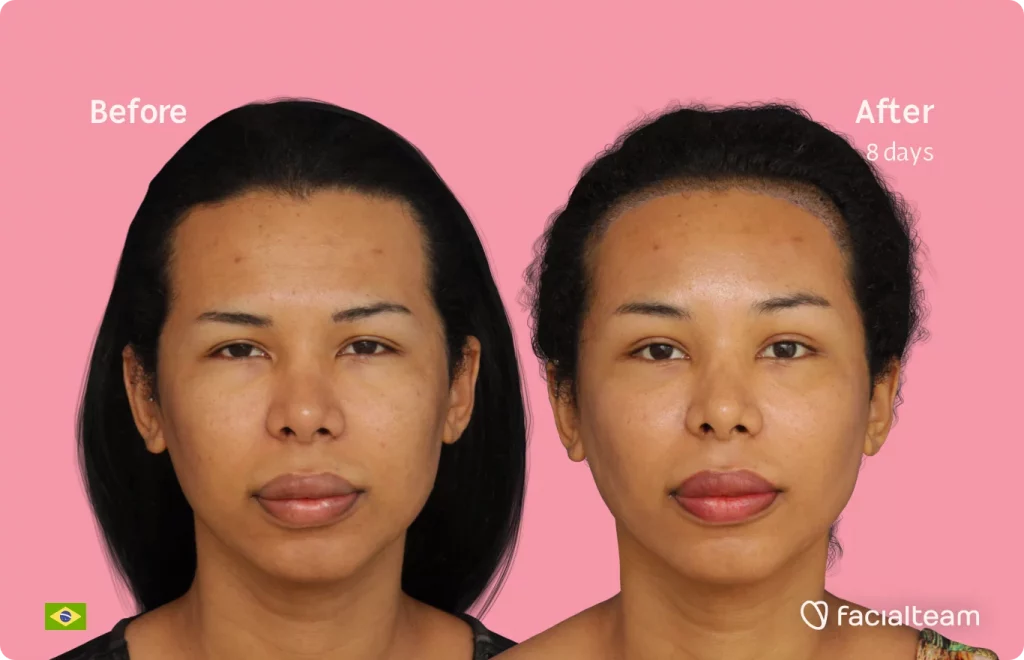 Frontal image of FFS patient Daniella showing the results before and after facial feminization surgery with Facialteam consisting of forehead with SHT feminization surgery.