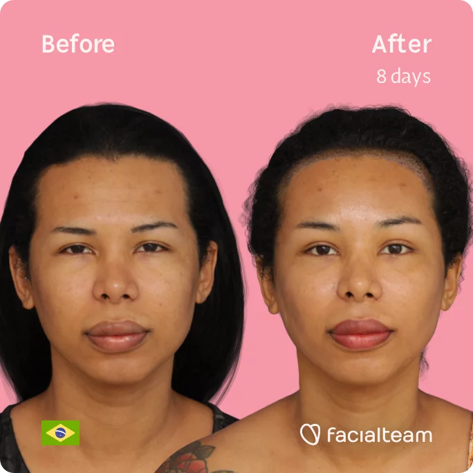 Square frontal image of FFS patient Daniella showing the results before and after facial feminization surgery with Facialteam consisting of forehead with SHT feminization surgery.