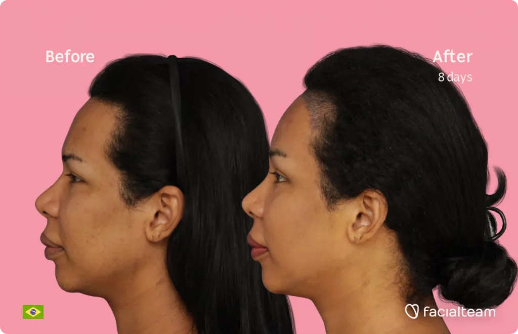 Side image of FFS patient Daniella showing the results before and after facial feminization surgery with Facialteam consisting of forehead with SHT feminization surgery.