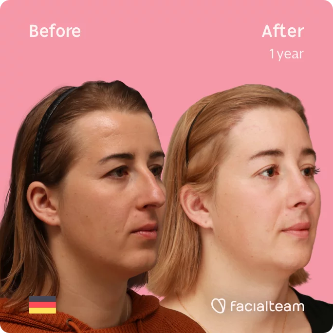 Square 45 degree image of FFS patient Karla showing the results before and after facial feminization surgery consisting of forehead with SHT, rhinoplasty, chin feminization surgery.