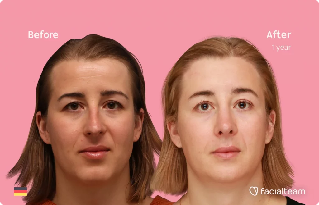 Frontal image of FFS patient Karla showing the results before and after facial feminization surgery with Facialteam consisting of forehead with SHT, rhinoplasty, chin feminization surgery.
