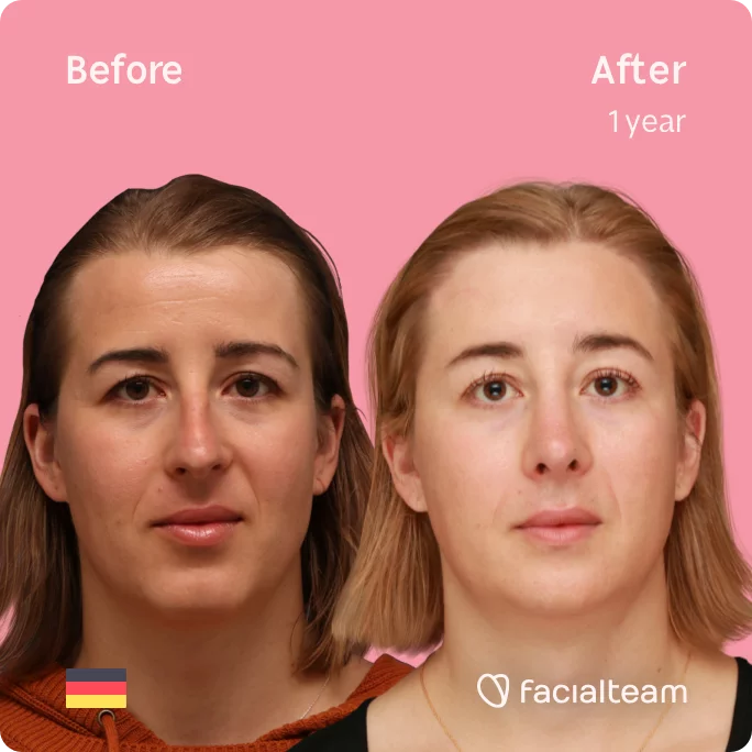 Square frontal image of FFS patient Karla showing the results before and after facial feminization surgery with Facialteam consisting of forehead with SHT, rhinoplasty, chin feminization surgery.