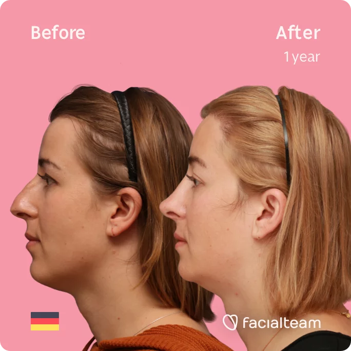 Square Side image of FFS patient Karla showing the results before and after facial feminization surgery with Facialteam consisting of forehead with SHT, rhinoplasty, chin feminization surgery.