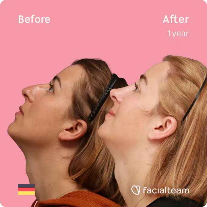 Square Side image of FFS patient Karla looking up showing the results before and after facial feminization surgery with Facialteam consisting of forehead with SHT, rhinoplasty, chin feminization surgery.