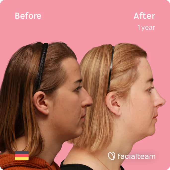 Right Square Side image of FFS patient Karla showing the results before and after facial feminization surgery with Facialteam consisting of forehead with SHT, rhinoplasty, chin feminization surgery.