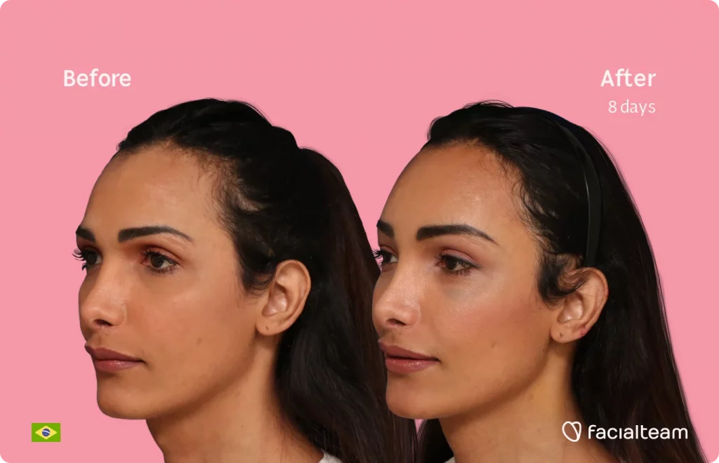 45 degree image of FFS patient Letícia showing the results before and after facial feminization surgery consisting of tracheal shave, forehead feminization surgery.