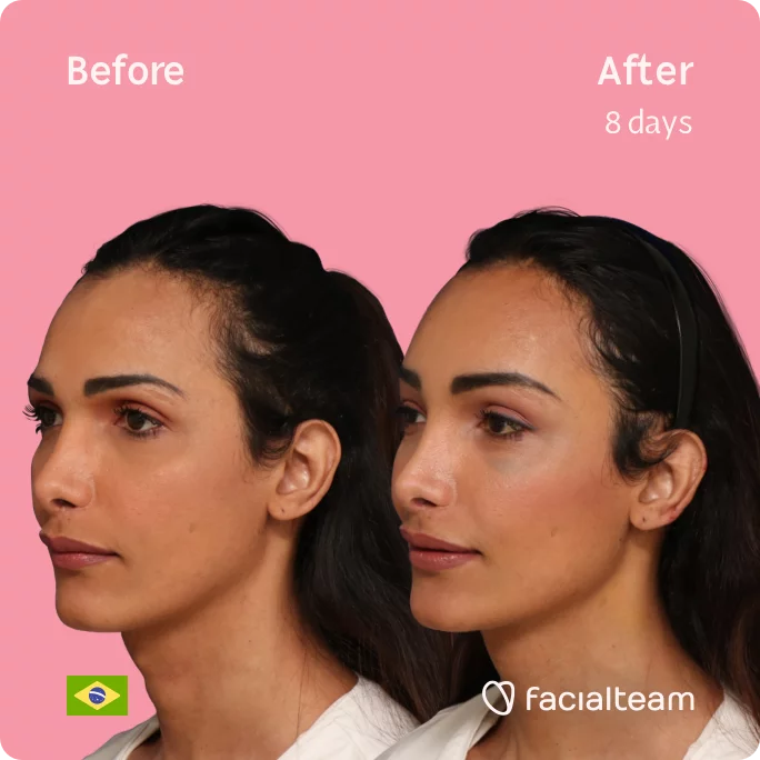 Square 45 degree image of FFS patient Letícia showing the results before and after facial feminization surgery consisting of tracheal shave, forehead feminization surgery.