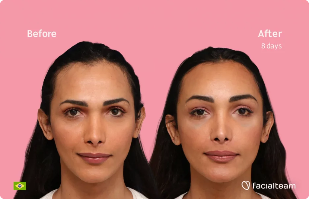 Frontal image of FFS patient Letícia showing the results before and after facial feminization surgery with Facialteam consisting of tracheal shave, forehead feminization surgery.