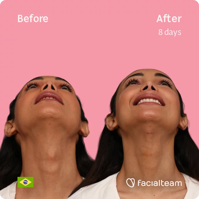 Square Frontal image of FFS patient Letícia looking up showing the results before and after facial feminization surgery with Facialteam consisting of tracheal shave, forehead feminization surgery.