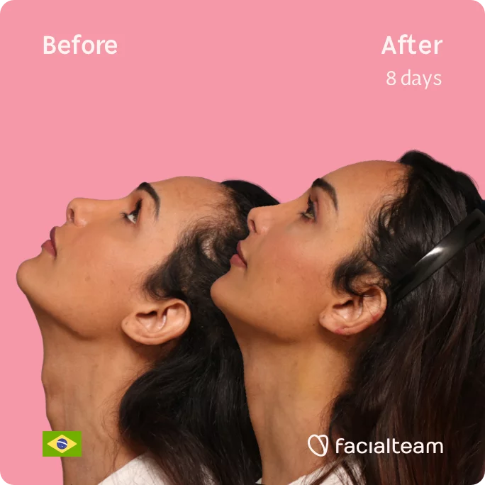 Square Side image of FFS patient Letícia looking up showing the results before and after facial feminization surgery with Facialteam consisting of tracheal shave, forehead feminization surgery.