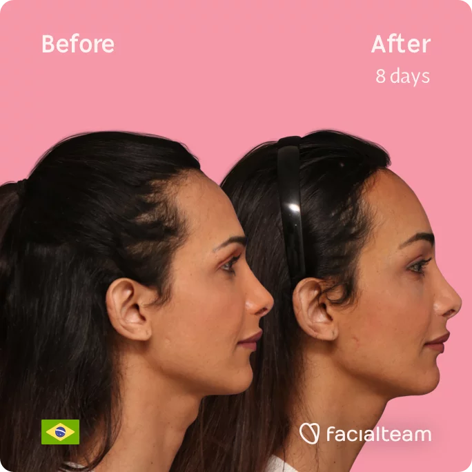 Square Side image of FFS patient Letícia showing the results before and after facial feminization surgery with Facialteam consisting of tracheal shave, forehead feminization surgery.