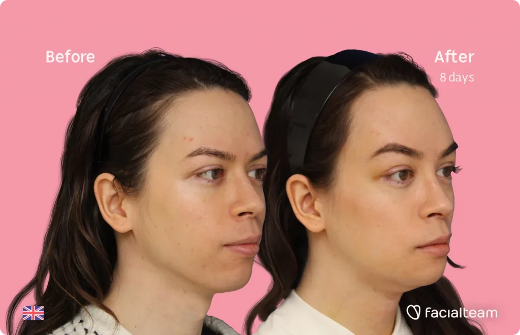 45 degree image of FFS patient Rachel showing the results before and after facial feminization surgery consisting of tracheal shave, forehead, chin, jaw feminization surgery.