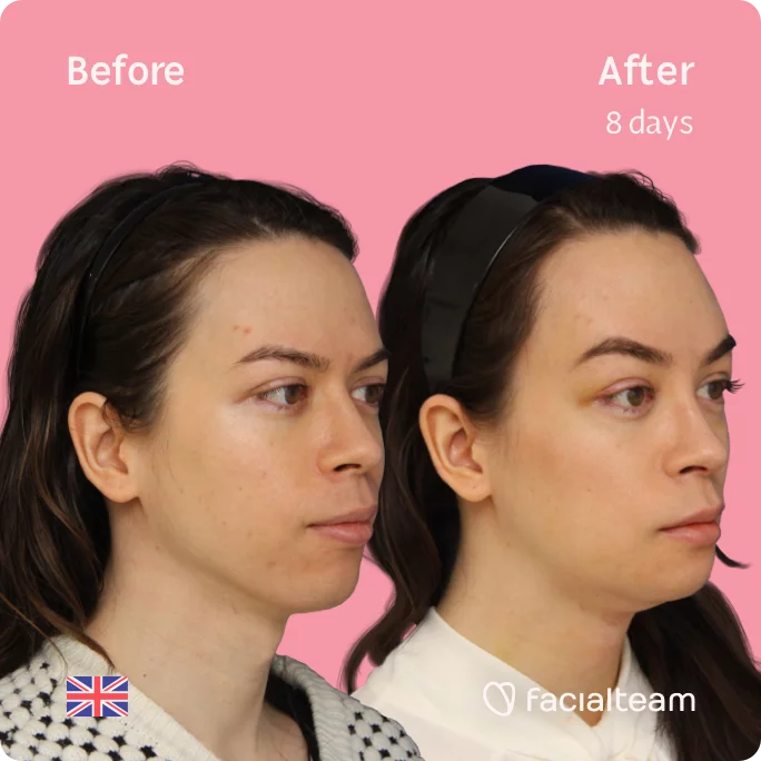 Square 45 degree image of FFS patient Rachel showing the results before and after facial feminization surgery consisting of tracheal shave, forehead, chin, jaw feminization surgery.