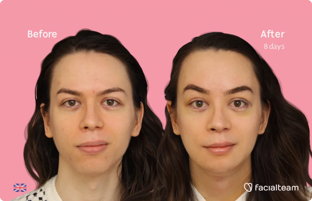 Frontal image of FFS patient Rachel showing the results before and after facial feminization surgery with Facialteam consisting of tracheal shave, forehead, chin, jaw feminization surgery.