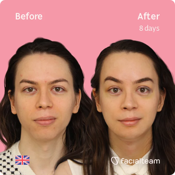 Square frontal image of FFS patient Rachel showing the results before and after facial feminization surgery with Facialteam consisting of tracheal shave, forehead, chin, jaw feminization surgery.