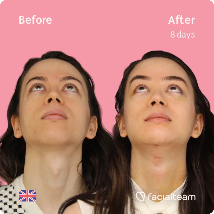 Square frontal image of FFS patient Rachel looking up showing the results before and after facial feminization surgery with Facialteam consisting of tracheal shave, forehead, chin, jaw feminization surgery.