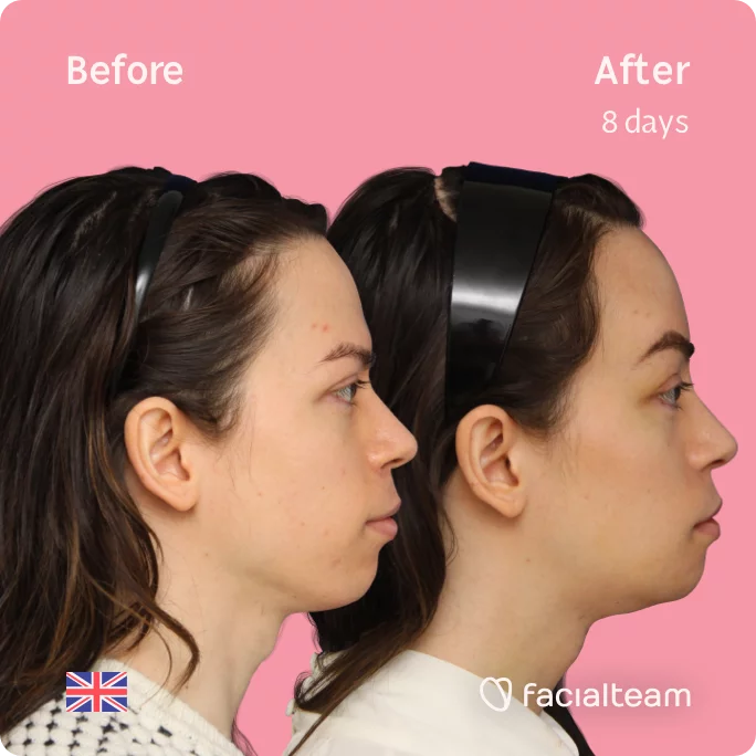 Square Side image of FFS patient Rachel showing the results before and after facial feminization surgery with Facialteam consisting of tracheal shave, forehead, chin, jaw feminization surgery.