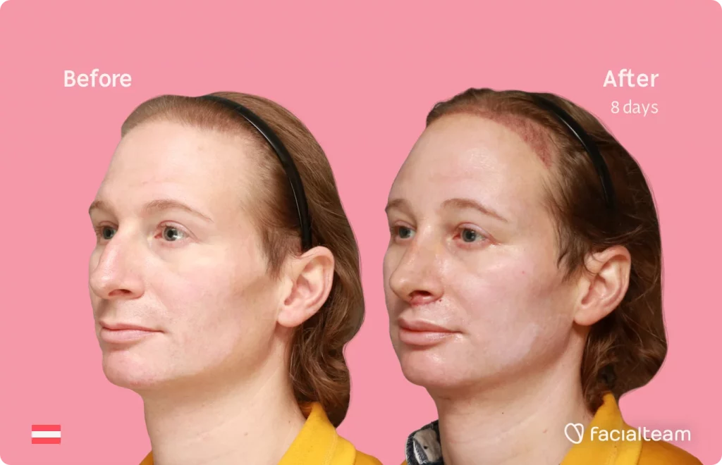 45 degree image of FFS patient Karina showing the results before and after facial feminization surgery consisting of tracheal shave, forehead with SHT, rhinoplasty, jaw feminization surgery.
