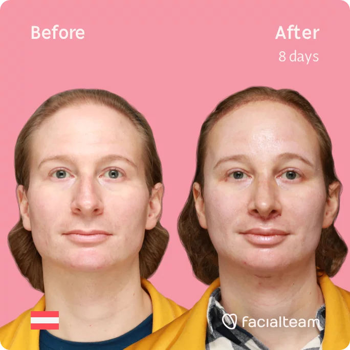 Square frontal image of FFS patient Karina showing the results before and after facial feminization surgery with Facialteam consisting of tracheal shave, forehead with SHT, rhinoplasty, jaw feminization surgery.