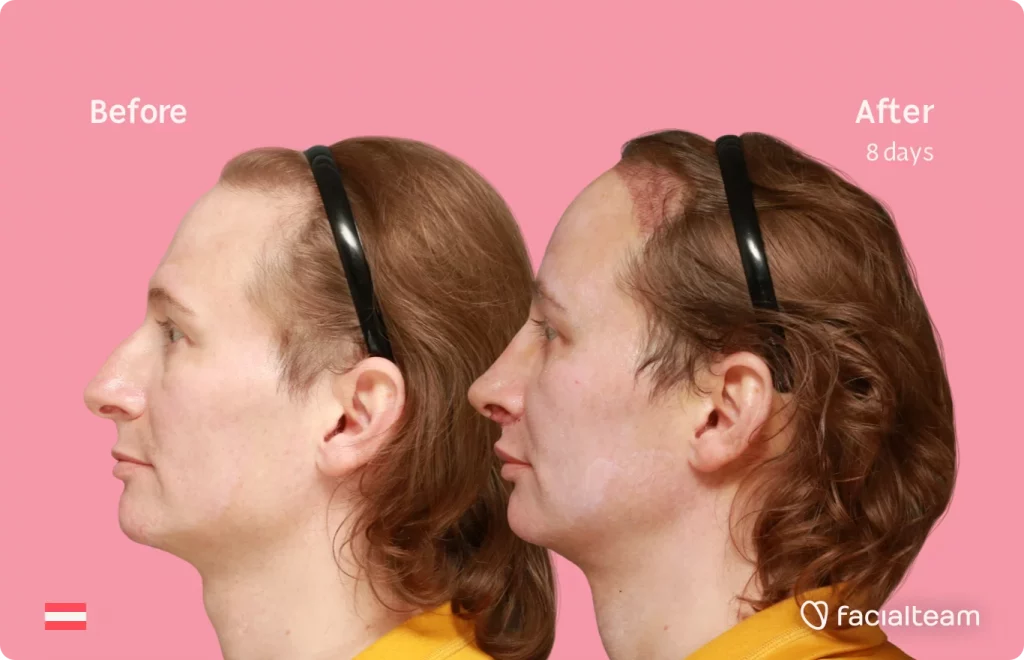 Side image of FFS patient Karina showing the results before and after facial feminization surgery with Facialteam consisting of tracheal shave, forehead with SHT, rhinoplasty, jaw feminization surgery.