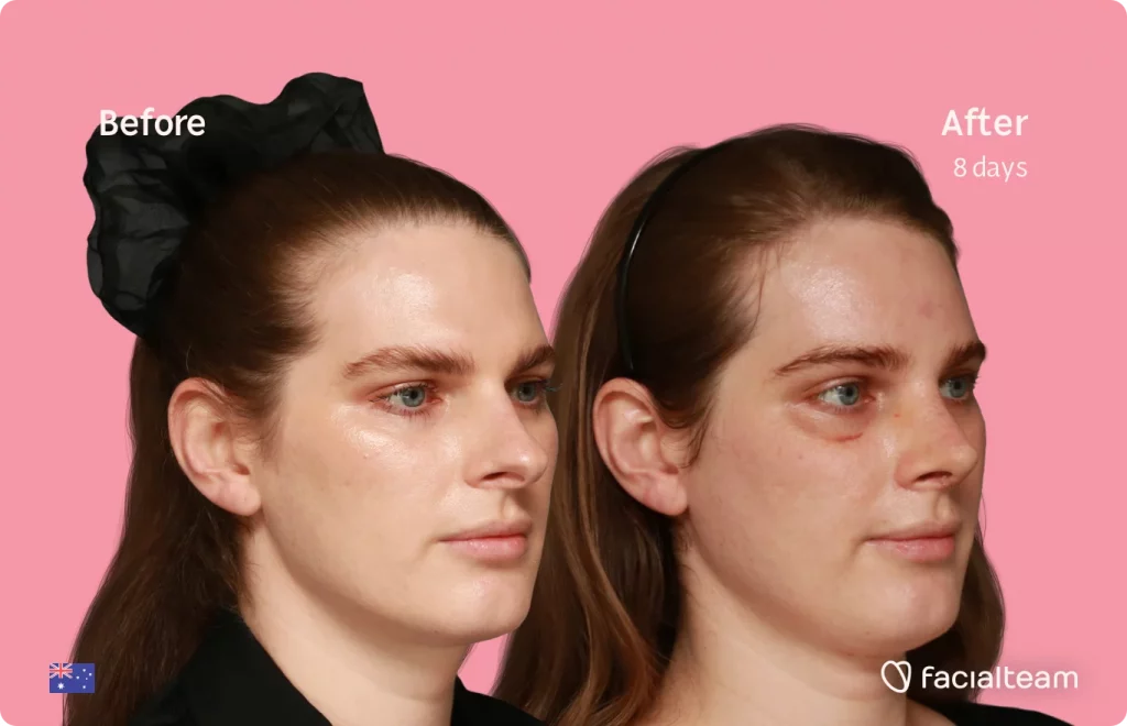 45 degree image of FFS patient Jade showing the results before and after facial feminization surgery consisting of tracheal shave, forehead, rhinoplasty feminization surgery.