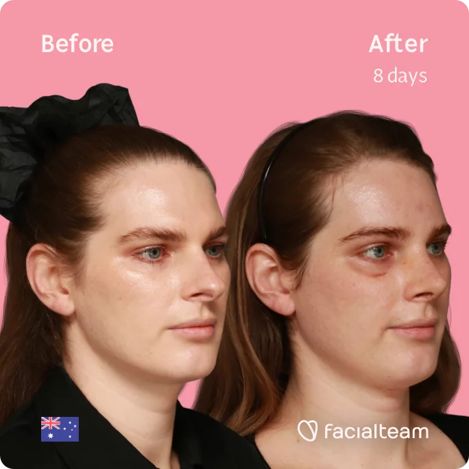 Square 45 degree image of FFS patient Jade showing the results before and after facial feminization surgery consisting of tracheal shave, forehead, rhinoplasty feminization surgery.