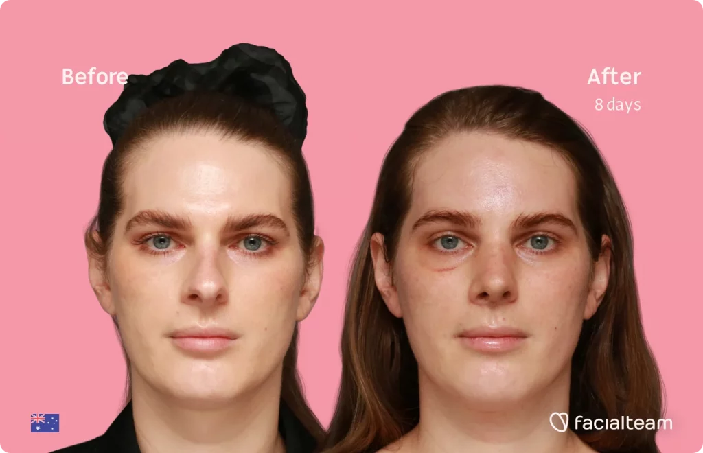 Frontal image of FFS patient Jade showing the results before and after facial feminization surgery with Facialteam consisting of tracheal shave, forehead, rhinoplasty feminization surgery.