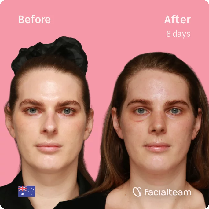 Square frontal image of FFS patient Jade showing the results before and after facial feminization surgery with Facialteam consisting of tracheal shave, forehead, rhinoplasty feminization surgery.