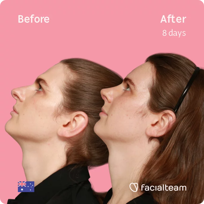 Left square Side image of FFS patient Jade showing the results before and after facial feminization surgery with Facialteam consisting of tracheal shave, forehead, rhinoplasty feminization surgery.