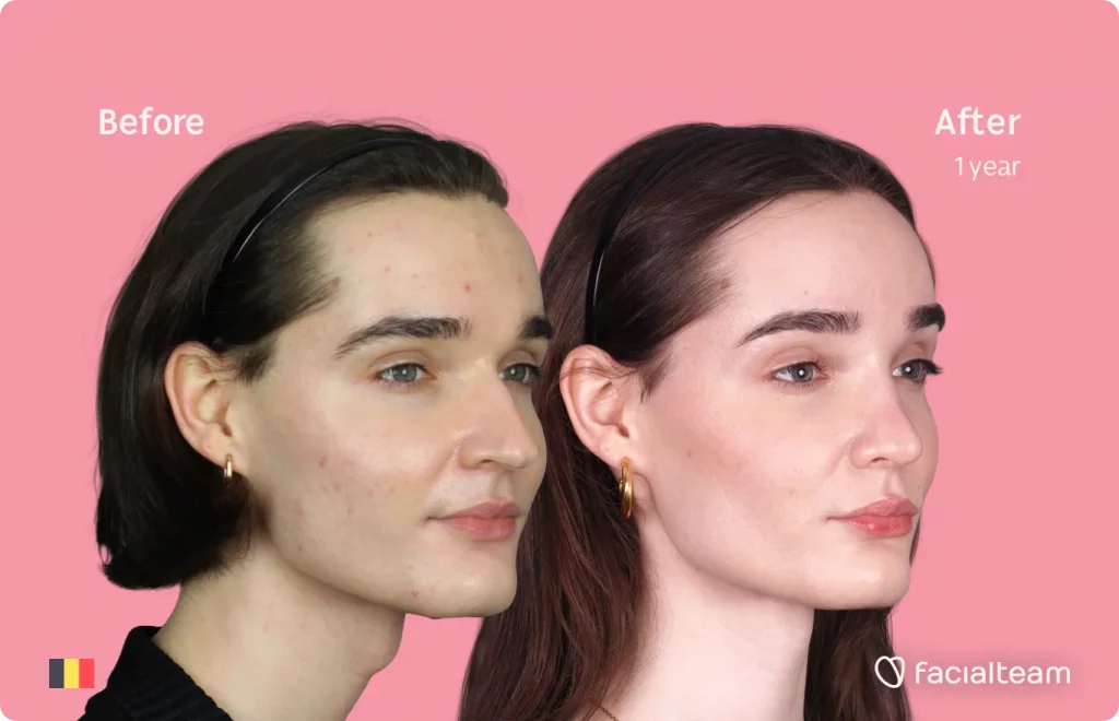 45 degree image of FFS patient Negin showing the results before and after facial feminization surgery consisting of tracheal shave, forehead, rhinoplasty feminization surgery.