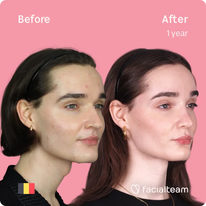 Square 45 degree image of FFS patient Negin showing the results before and after facial feminization surgery consisting of tracheal shave, forehead, rhinoplasty feminization surgery.