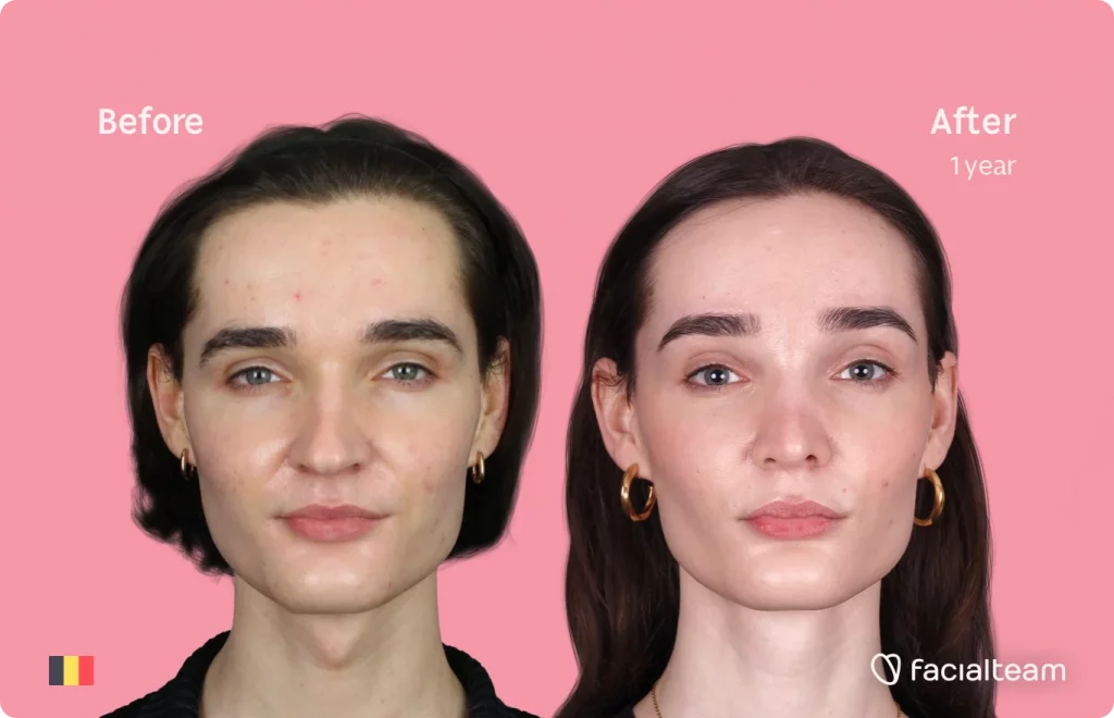 Frontal image of FFS patient Negin showing the results before and after facial feminization surgery with Facialteam consisting of tracheal shave, forehead, rhinoplasty feminization surgery.