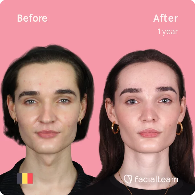 Square frontal image of FFS patient Negin showing the results before and after facial feminization surgery with Facialteam consisting of tracheal shave, forehead, rhinoplasty feminization surgery.