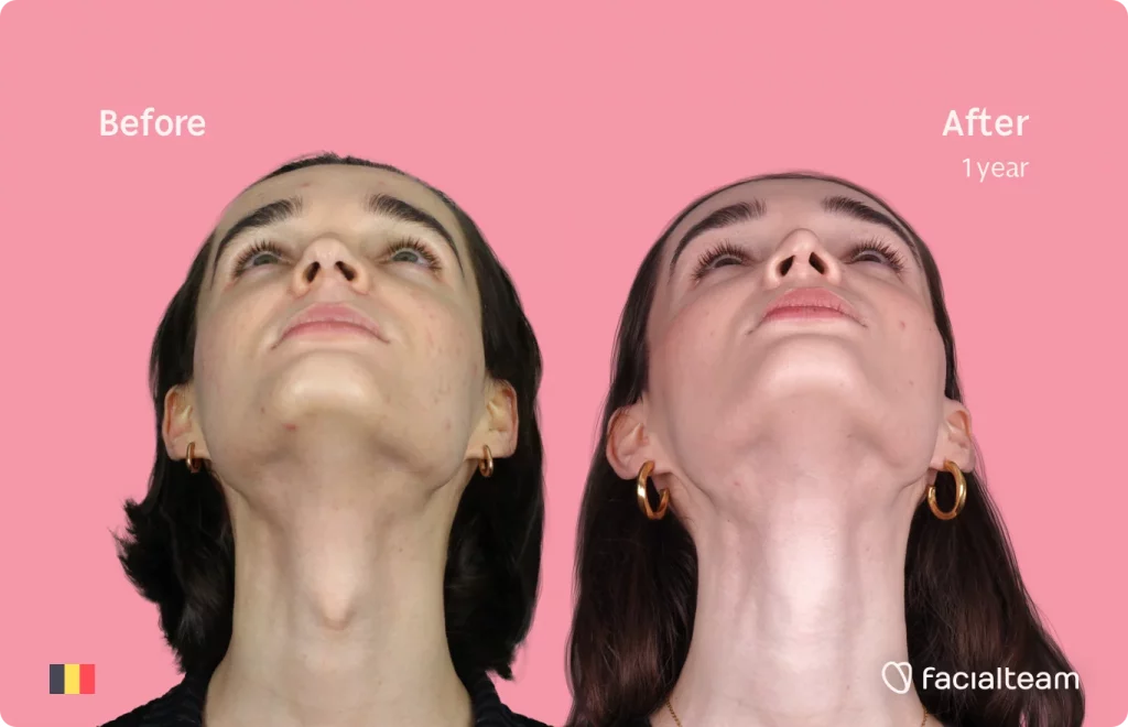 Frontal image of FFS patient Negin looking up showing the results before and after facial feminization surgery with Facialteam consisting of tracheal shave, forehead, rhinoplasty feminization surgery.