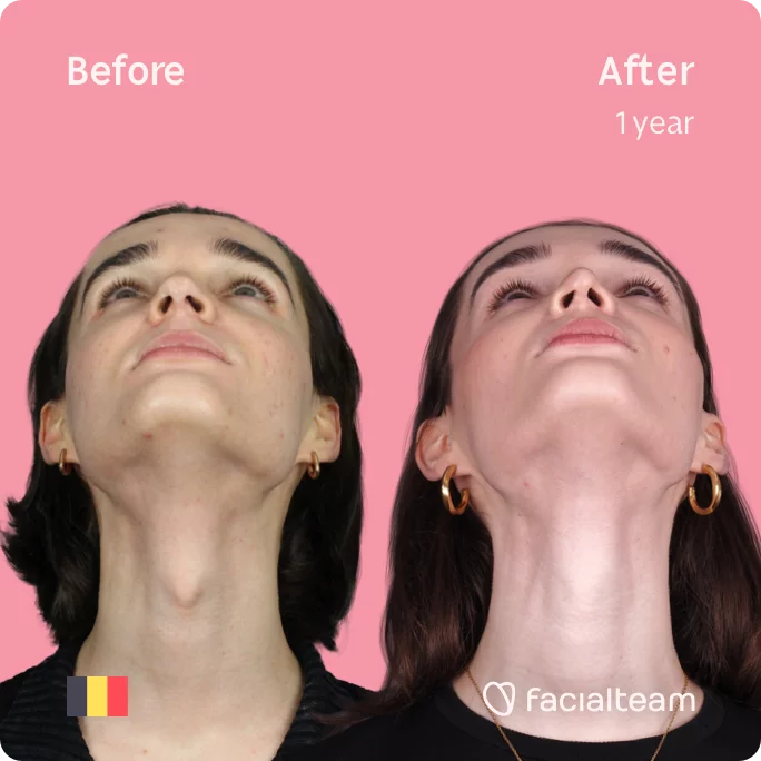 Square frontal image of FFS patient Negin looking up showing the results before and after facial feminization surgery with Facialteam consisting of tracheal shave, forehead, rhinoplasty feminization surgery.