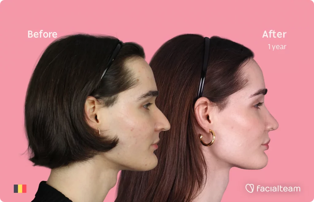Side image of FFS patient Negin showing the results before and after facial feminization surgery with Facialteam consisting of tracheal shave, forehead, rhinoplasty feminization surgery.