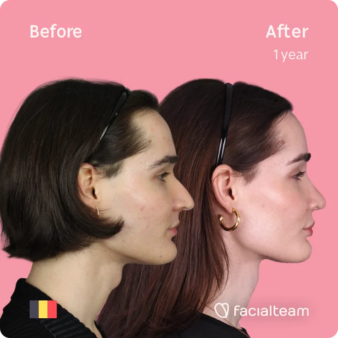 Square Side image of FFS patient Negin showing the results before and after facial feminization surgery with Facialteam consisting of tracheal shave, forehead, rhinoplasty feminization surgery.