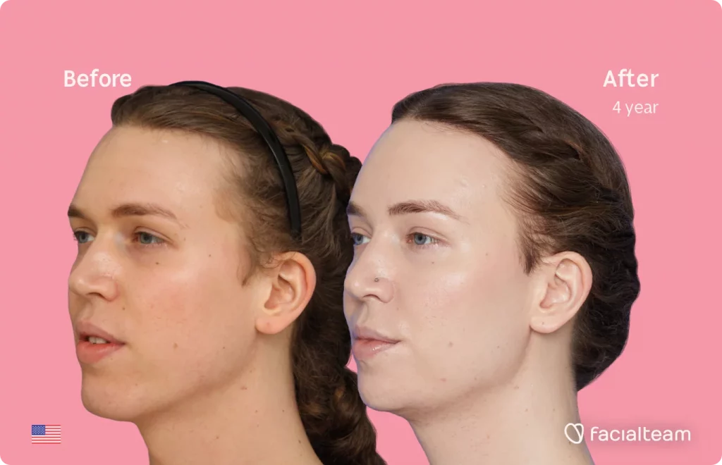 Left 45 degree image of FFS patient Corey showing the results before and after facial feminization surgery consisting of tracheal shave, forehead with SHT, jaw, chin feminization surgery.