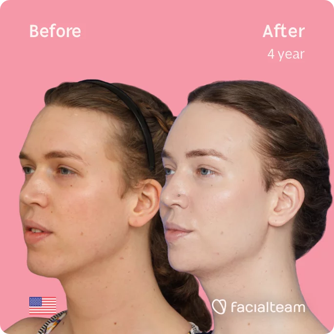 Left square 45 degree image of FFS patient Corey showing the results before and after facial feminization surgery consisting of tracheal shave, forehead with SHT, jaw, chin feminization surgery.