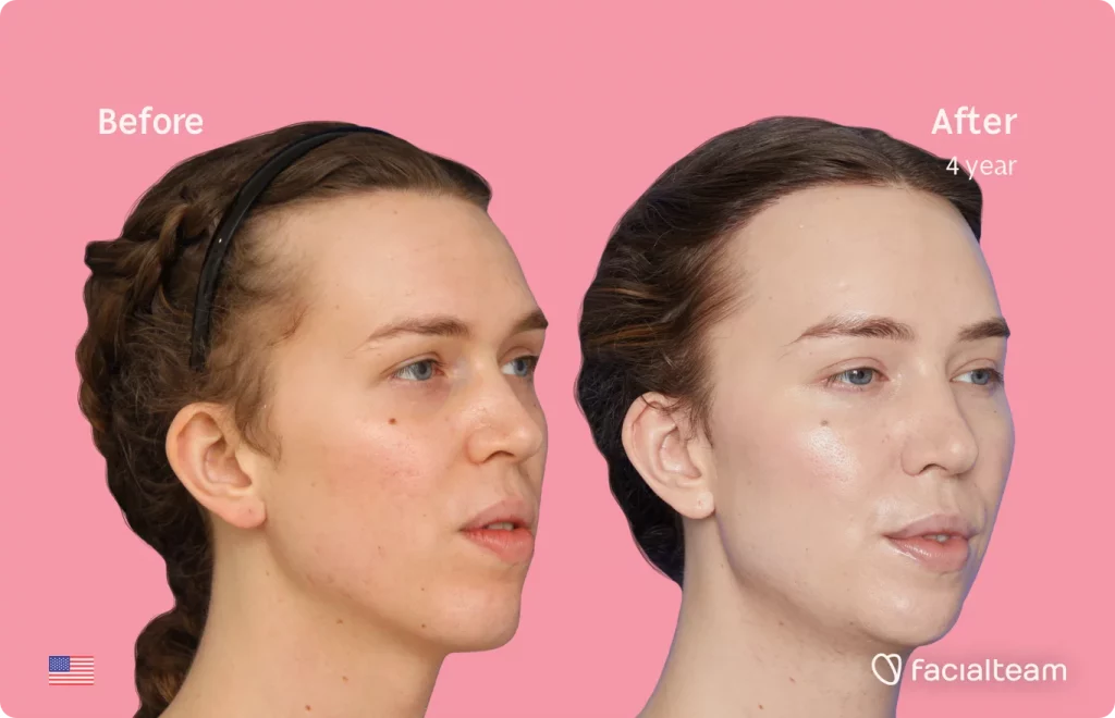 Right 45 degree image of FFS patient Corey showing the results before and after facial feminization surgery consisting of tracheal shave, forehead with SHT, jaw, chin feminization surgery.