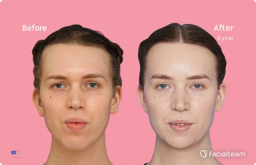 Frontal image of FFS patient Corey showing the results before and after facial feminization surgery with Facialteam consisting of tracheal shave, forehead with SHT, jaw, chin feminization surgery.