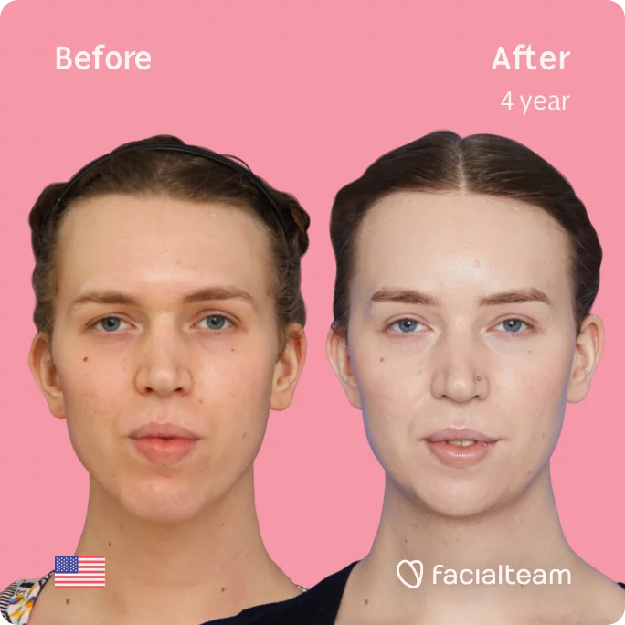 Square frontal image of FFS patient Corey showing the results before and after facial feminization surgery with Facialteam consisting of tracheal shave, forehead with SHT, jaw, chin feminization surgery.