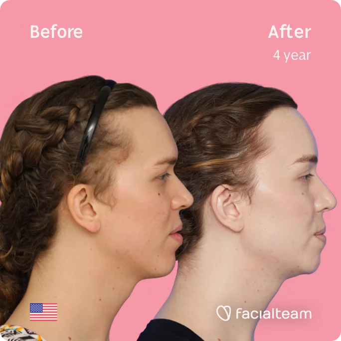 Square Side image of FFS patient Corey showing the results before and after facial feminization surgery with Facialteam consisting of tracheal shave, forehead with SHT, jaw, chin feminization surgery.