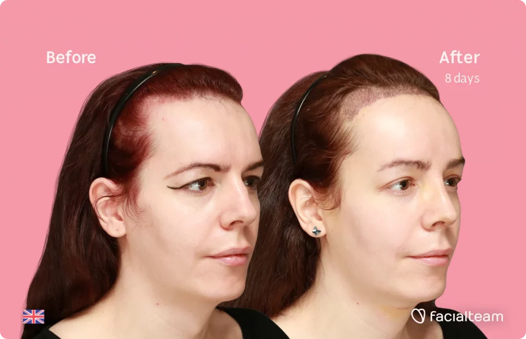 45 degree image of FFS patient Amber showing the results before and after facial feminization surgery consisting of tracheal shave, forehead with SHT, rhinoplasty feminization surgery.