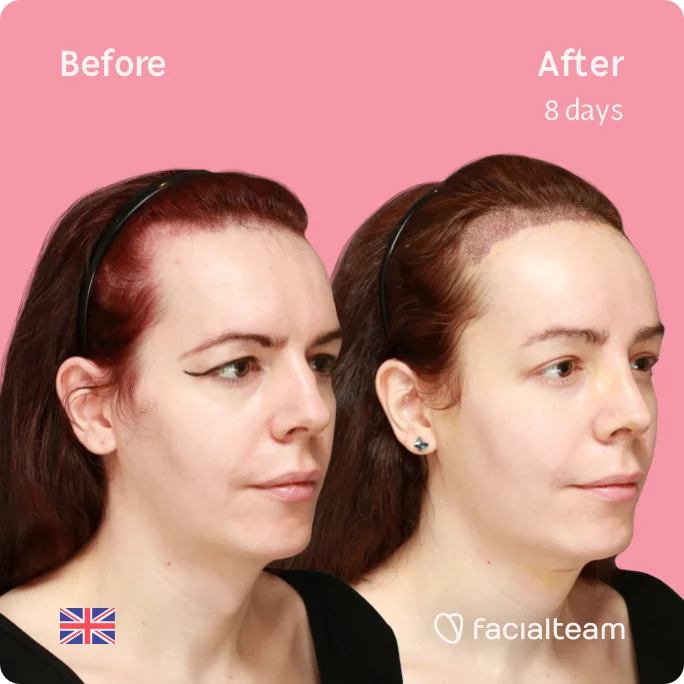 Square 45 degree image of FFS patient Amber showing the results before and after facial feminization surgery consisting of tracheal shave, forehead with SHT, rhinoplasty feminization surgery.