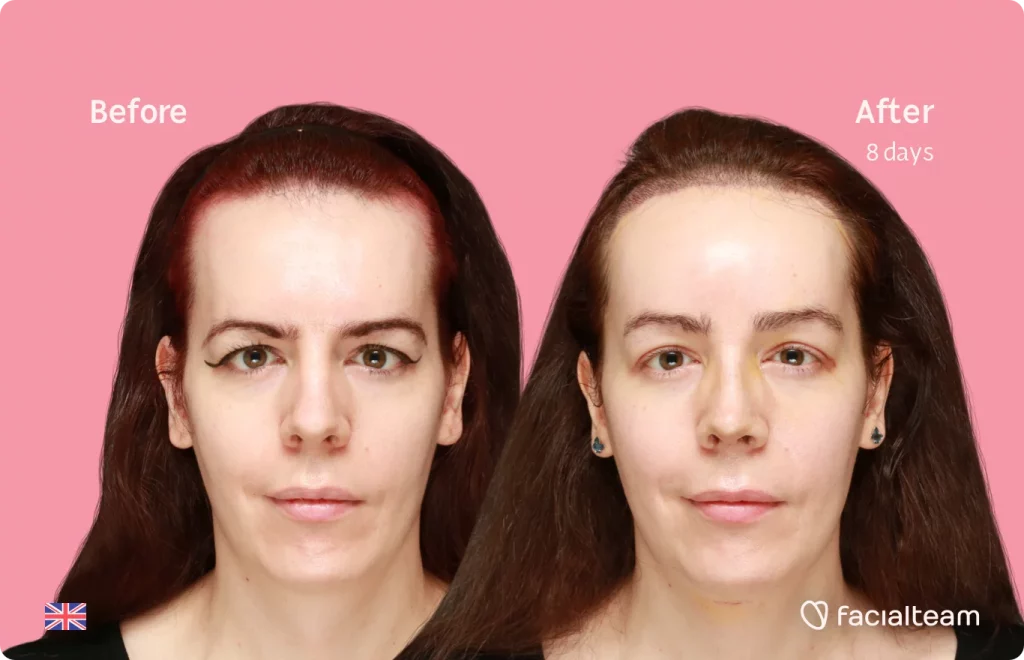 Frontal image of FFS patient Amber showing the results before and after facial feminization surgery with Facialteam consisting of tracheal shave, forehead with SHT, rhinoplasty feminization surgery.