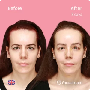 FFS patient Amber from the UK before and after FFS Surgery with Facialteam, she underwent a tracheal shave, forehead feminization and a feminizing rhinoplasty